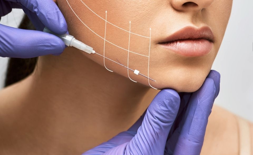 Thread Lift
