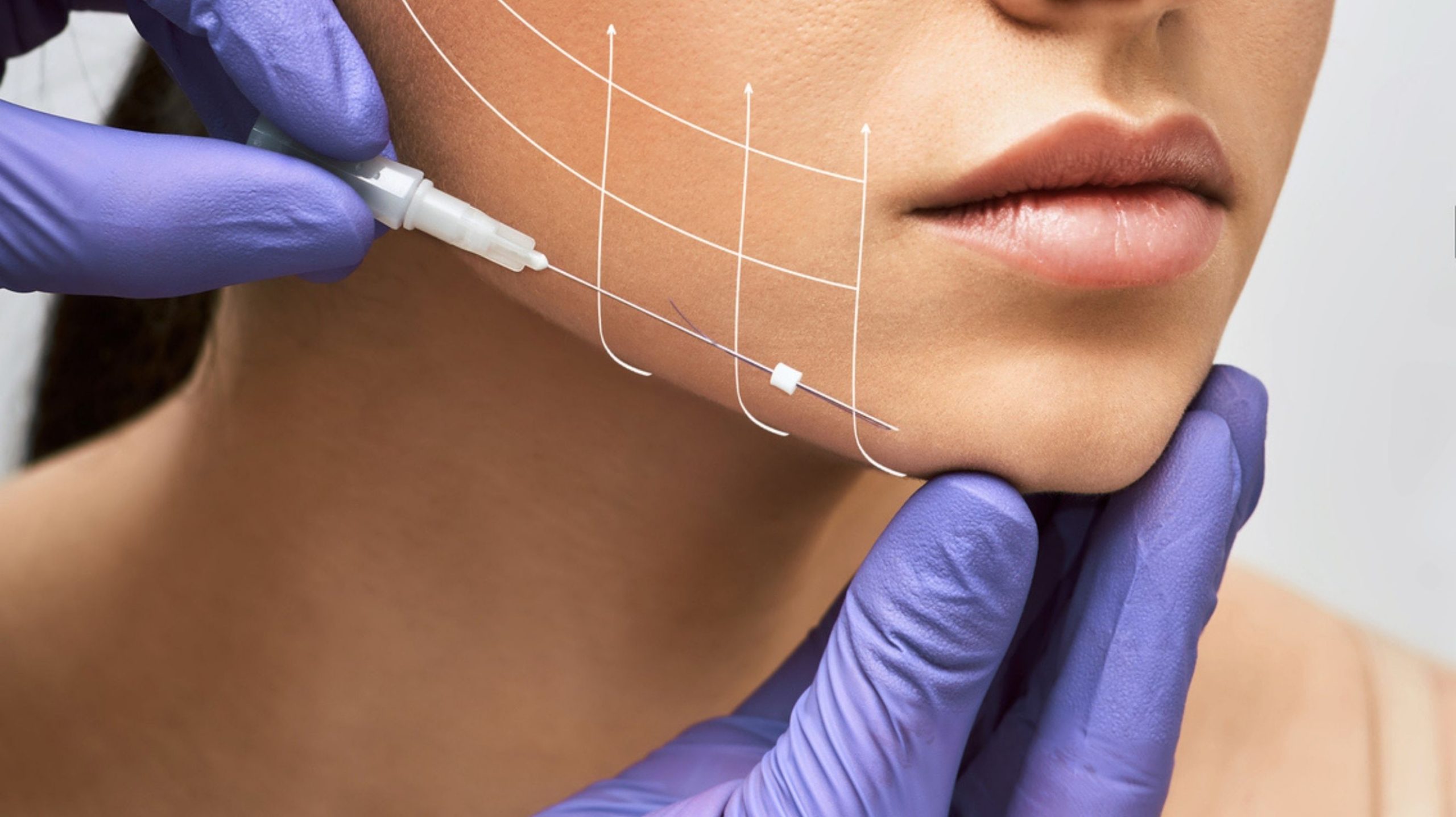 Thread Lift | Skin Institute