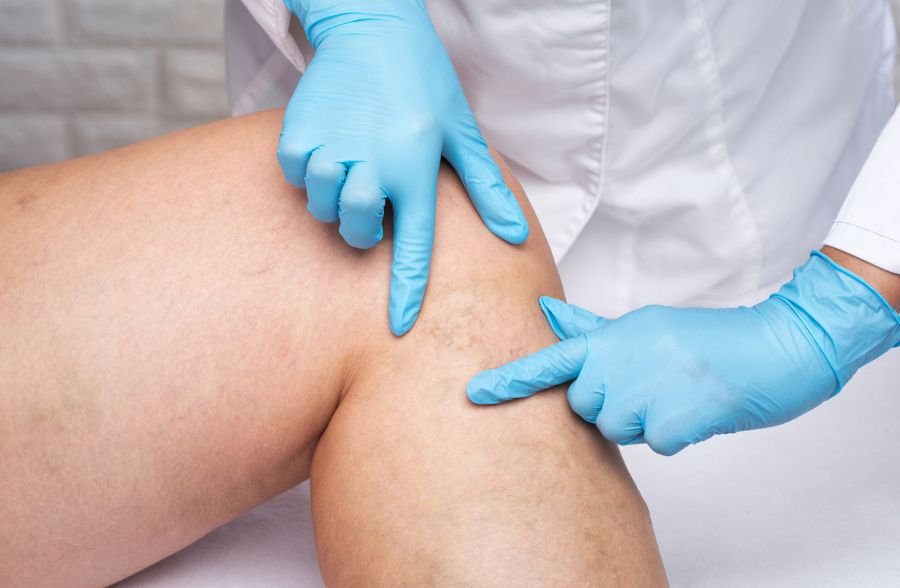 Free Vein Assessment