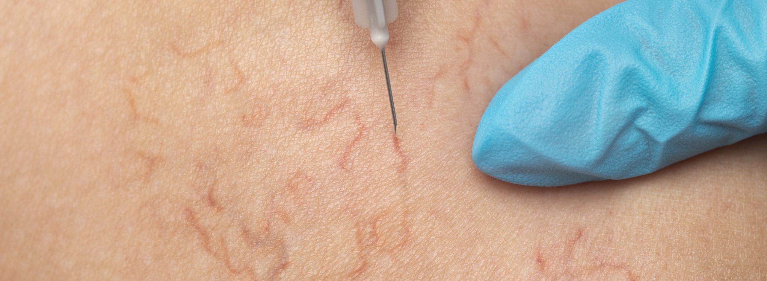 A doctor underaking a Microsclerotherapy procedure on a patient's veins in their leg