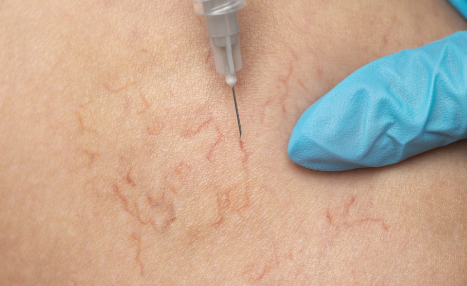 Microsclerotherapy