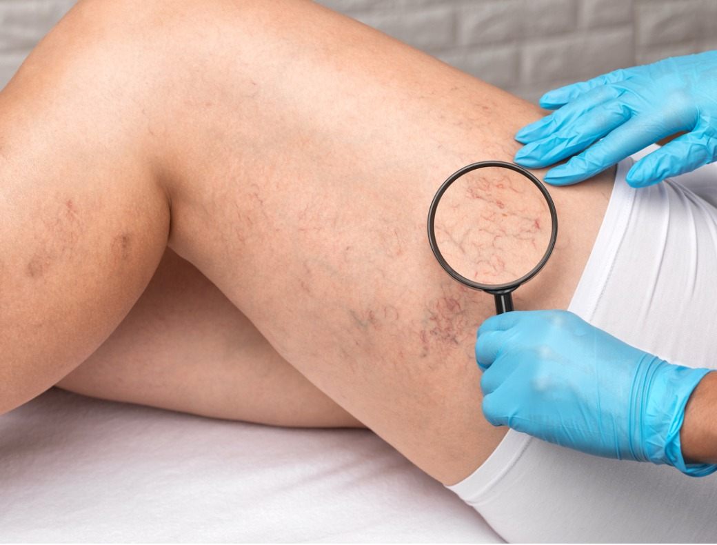 Spider veins, Symptoms & Causes